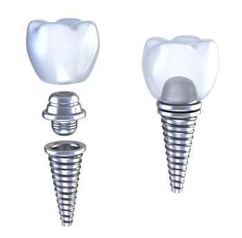 Diagram of Dental Implants from South Main Dental in Pontotoc, MS Diagram of Dental Implants from South Main Dental in Pontotoc, MS